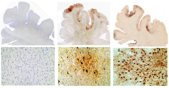 Tau immunostained sections of frontal cortex