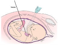 Fetal Heart Surgery