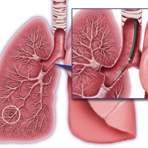 The Percepta test, performed at the same time as a bronchoscopy, uses a small brush to sample normal-looking cells in the upper airway. Genetic markers in the cells indicate the likelihood of lung cancer