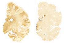 Human brain samples showing CTE (chronic traumatic encephalopathy) in teenage brains