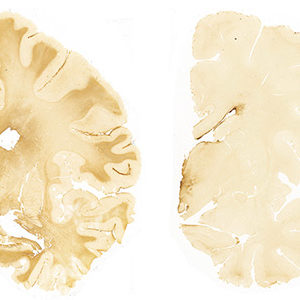 Human brain samples showing CTE (chronic traumatic encephalopathy) in teenage brains