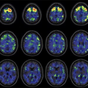 these images show areas of the brain where an experimental brain scan detected higher abnormal tau protein in a group of former NFL football players than compared to a group of control subjects. The former football players in the study have self-reported cognitive, mood, and behavior symptoms that are thought to be associated with CTE