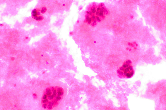 Metastatic Breast Cancer in Pleural Fluid