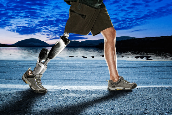 iWalk BiOM prosthetic ankle, amputee walking