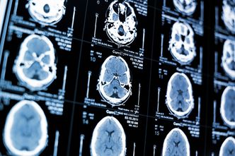 Marlene Oscar Berman, Susan Mosher Ruiz, Boston University School of Medicine, neurobiology, neurology, neuroscience, alcoholism effects on the human brain, how alcohol effects the brain, alcoholism and gender
