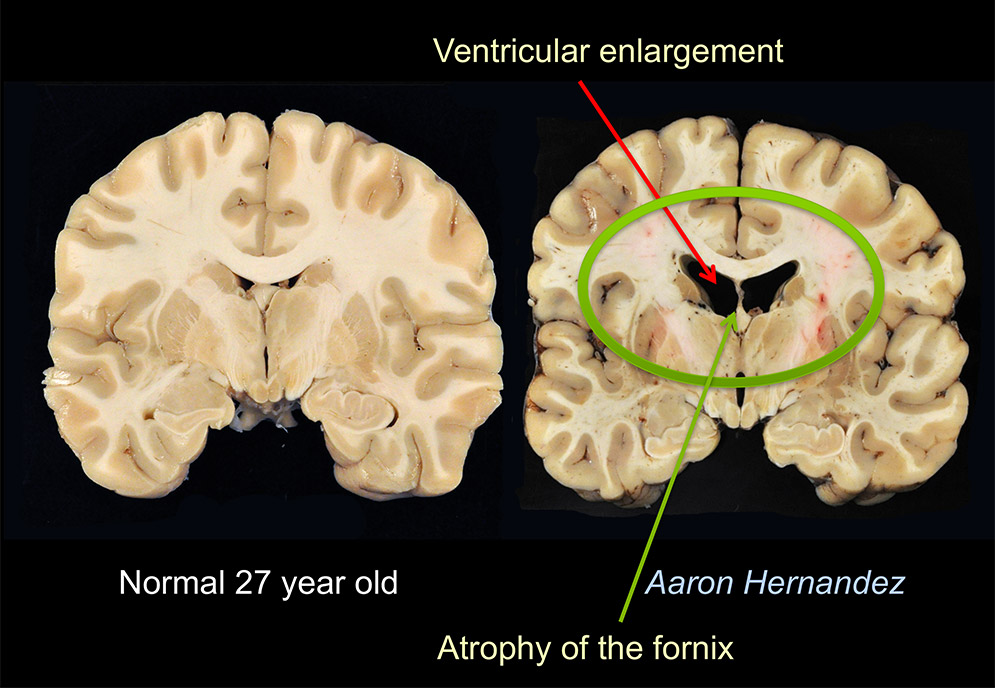 Scientific figure showing images of CTE in Aaron Hernandez's brain compared to a normal 27 year old brain