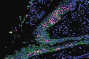 In this microscopic image of precancerous lung tissue, the hot pink cells are dividing faster than in normal lung tissue. Credit: Beane, et al., Nature Communications