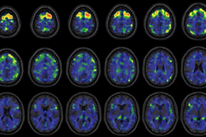 These images show areas of the brain where an experimental brain scan detected higher abnormal tau protein in a group of former NFL football players than compared to a group of a control subjects. The former football players in the study have self reported cognitive, mood and behavior symptoms that are thought to be associated with CTE. Courtesy of the New England Journal of Medicine