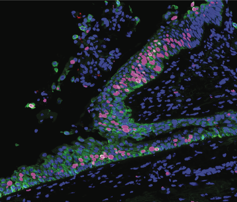 In this microscopic image of precancerous lung tissue, the hot pink cells are reproducing faster than in normal lung tissue. Credit: Beane, et al., Nature Communications