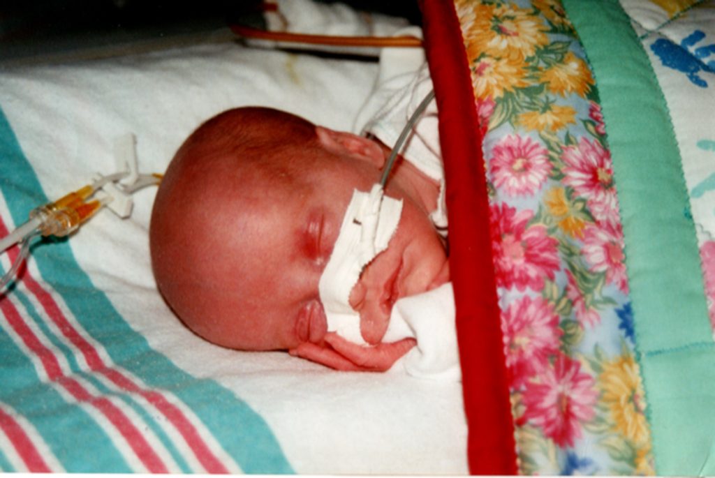 A photo of Lena Papadakis as an infant. Her eyes are closed and a tube is taped into her nose.