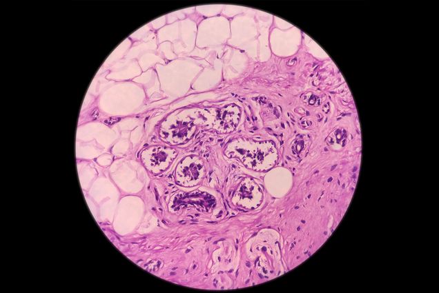 Microscopic image of malignant melanoma in pink pigmented ulcer.