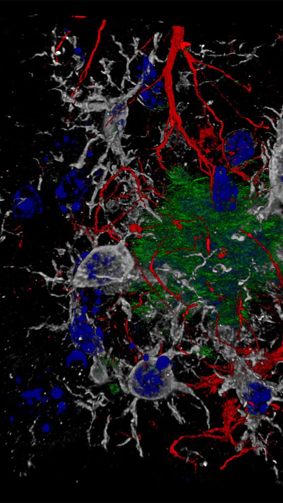 Photo: This image shows microglia and astrocytes, components of our brain's immune system, in the heat of battle against those beta-amyloid protein plaques, the drivers of the concatenation of events presented above. Being able to study them at this level of detail will allow us to better understand the pathology and, hopefully in the near future, to develop effective therapies against the origin of the disease. Image taken with reflection confocal and/or scanning spectral fluorescence microscope LEICA Stellaris 8. Objective: HCX PL APO 63x/1.30 Glyc W.D. 0.30 mm. Composite made from 43 Z-planes with LASX 3D software and post-processed with FIJI.