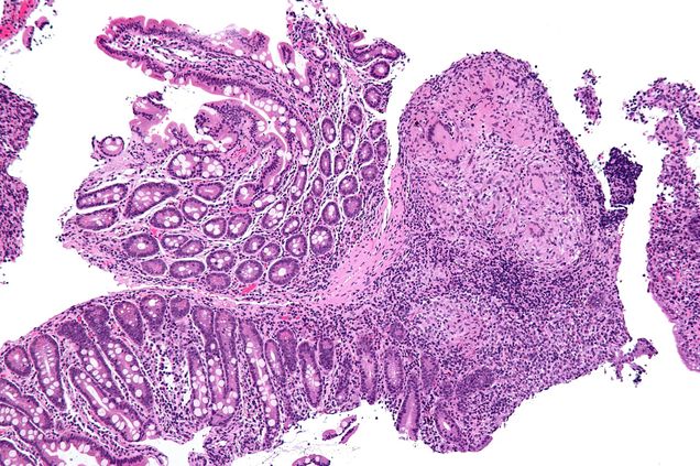 Crohn's disease is an example of an autoimmune disease.  Credit | Nephron (Own work)