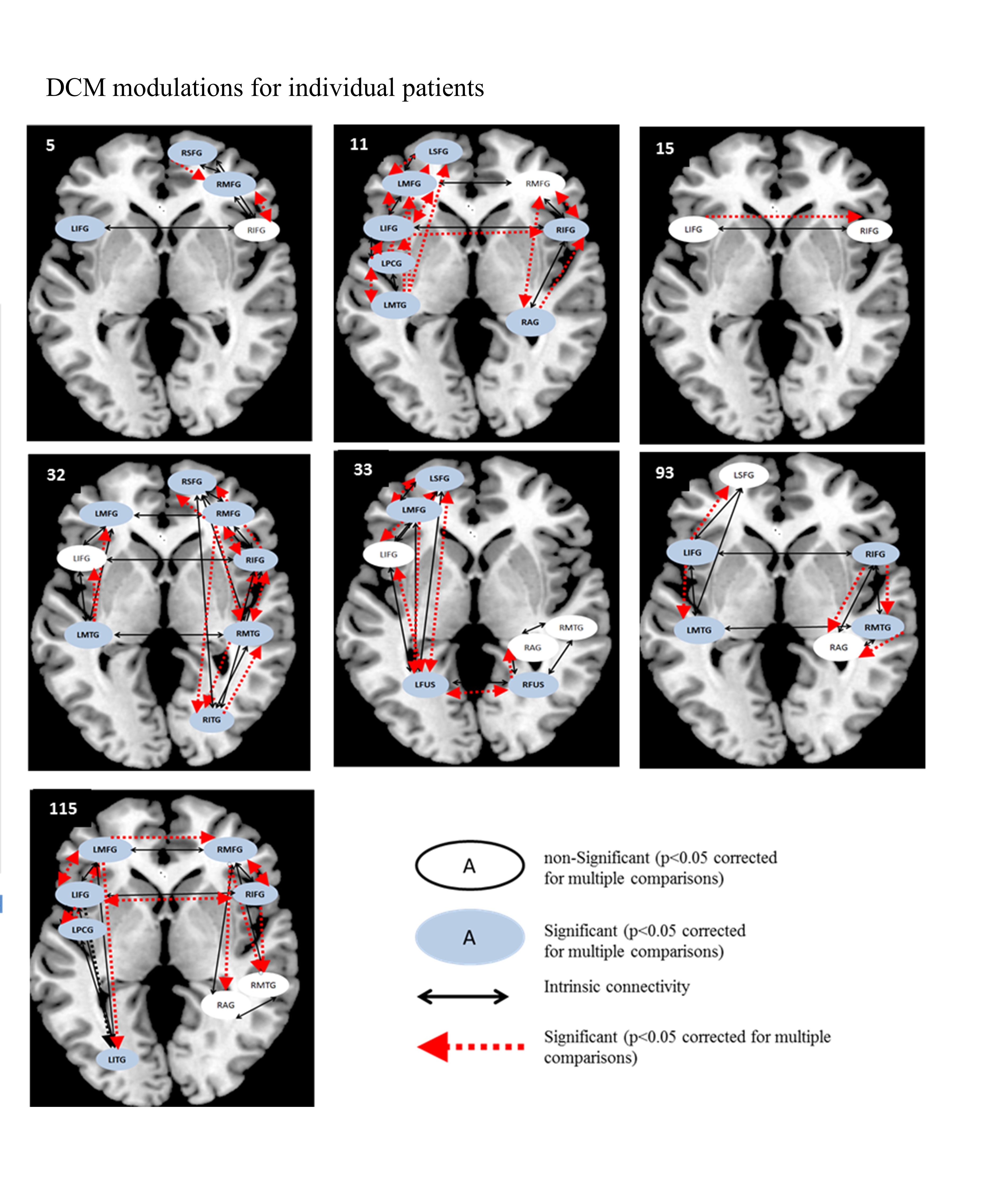 Figure 8. DCM connectivity map for patients for semantic feature ...