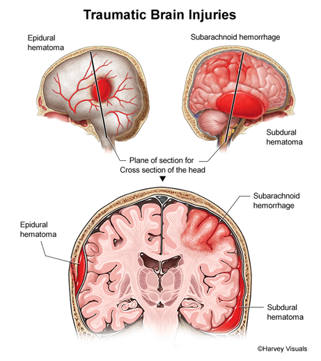 research papers about traumatic brain injury