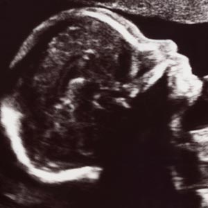 pregnancy, opioid use, birth defects, Martha Werler, professor of epidemiology, chair of epidemiology, Boston University School of Public Health, SPH