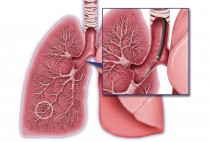 The Percepta test, performed at the same time as a bronchoscopy, uses a small brush to sample normal-looking cells in the upper airway. Genetic markers in the cells indicate the likelihood of lung cancer