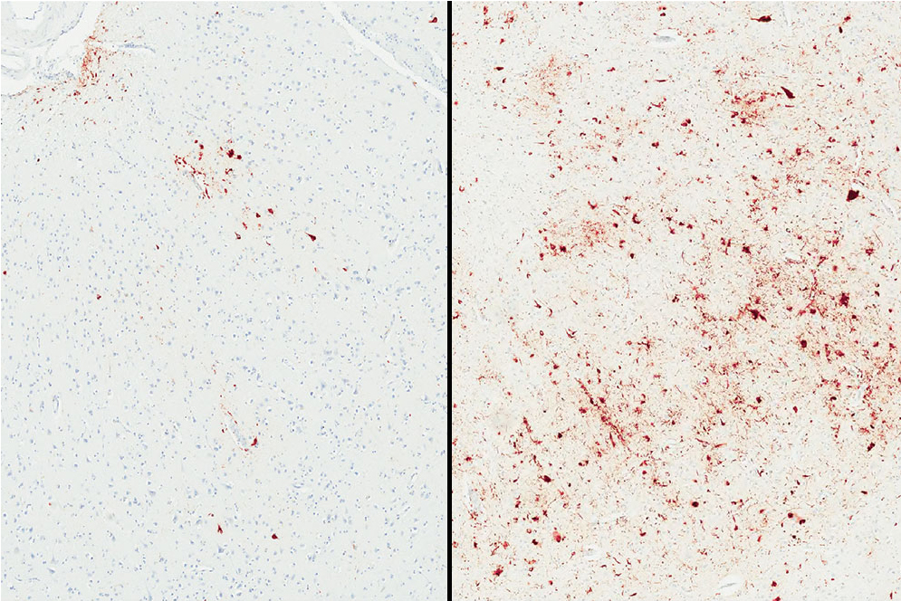 Side-by-side comparison of microscopic images of p-tau in brain tissue. On the left, p-tau in the brain tissue of a deceased person with the "minor" genetic variation of the TMEM106B protein. On the right, high accumulations of p-tau in the brain tissue of a deceased person with the "major" genetic variation of the TMEM106B protein.