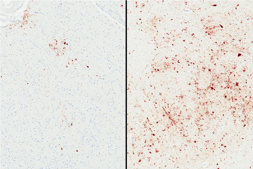 Side-by-side comparison of microscopic images of p-tau in brain tissue. On the left, p-tau in the brain tissue of a deceased person with the "minor" genetic variation of the TMEM106B protein. On the right, high accumulations of p-tau in the brain tissue of a deceased person with the "major" genetic variation of the TMEM106B protein.