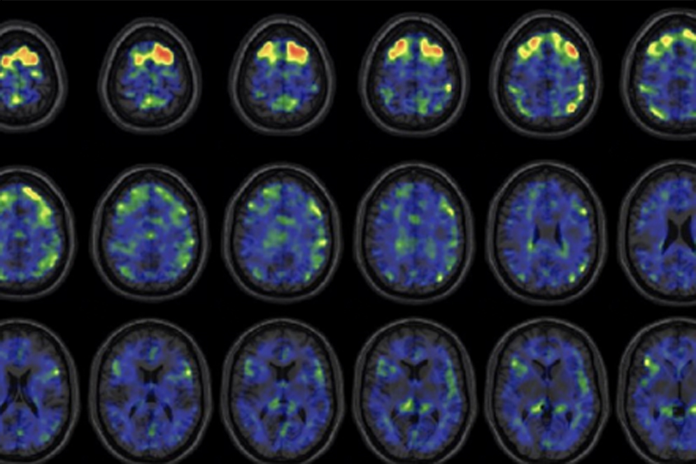 these images show areas of the brain where an experimental brain scan detected higher abnormal tau protein in a group of former NFL football players than compared to a group of control subjects. The former football players in the study have self-reported cognitive, mood, and behavior symptoms that are thought to be associated with CTE