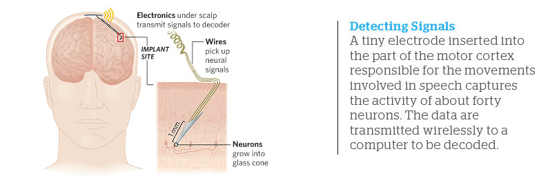 Detecting Signals: A tiny electrode inserted into the part of the motor cortex responsible for the movements involved in speech captures the activity of about forty neurons. The data are transmitted wirelessly to a computer to be decoded.