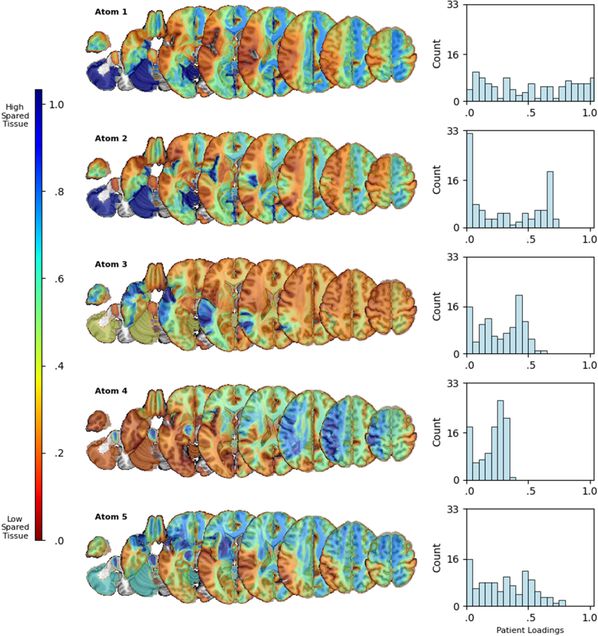 Nonnegative matrix factorization atoms visualizations on the MNI152 template and distributions of patient loadings per atom. Left hemisphere gray and white matter regions were colored by intensity based on component weights from matrix W