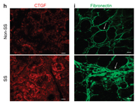 kukuruzinska_research-200 (left column) Immunofluorescence localization of connective tissue growth factor in SS and non-SS glands. (right column) Immunofluorescence localization of fibronectin in SS and non-SS glands