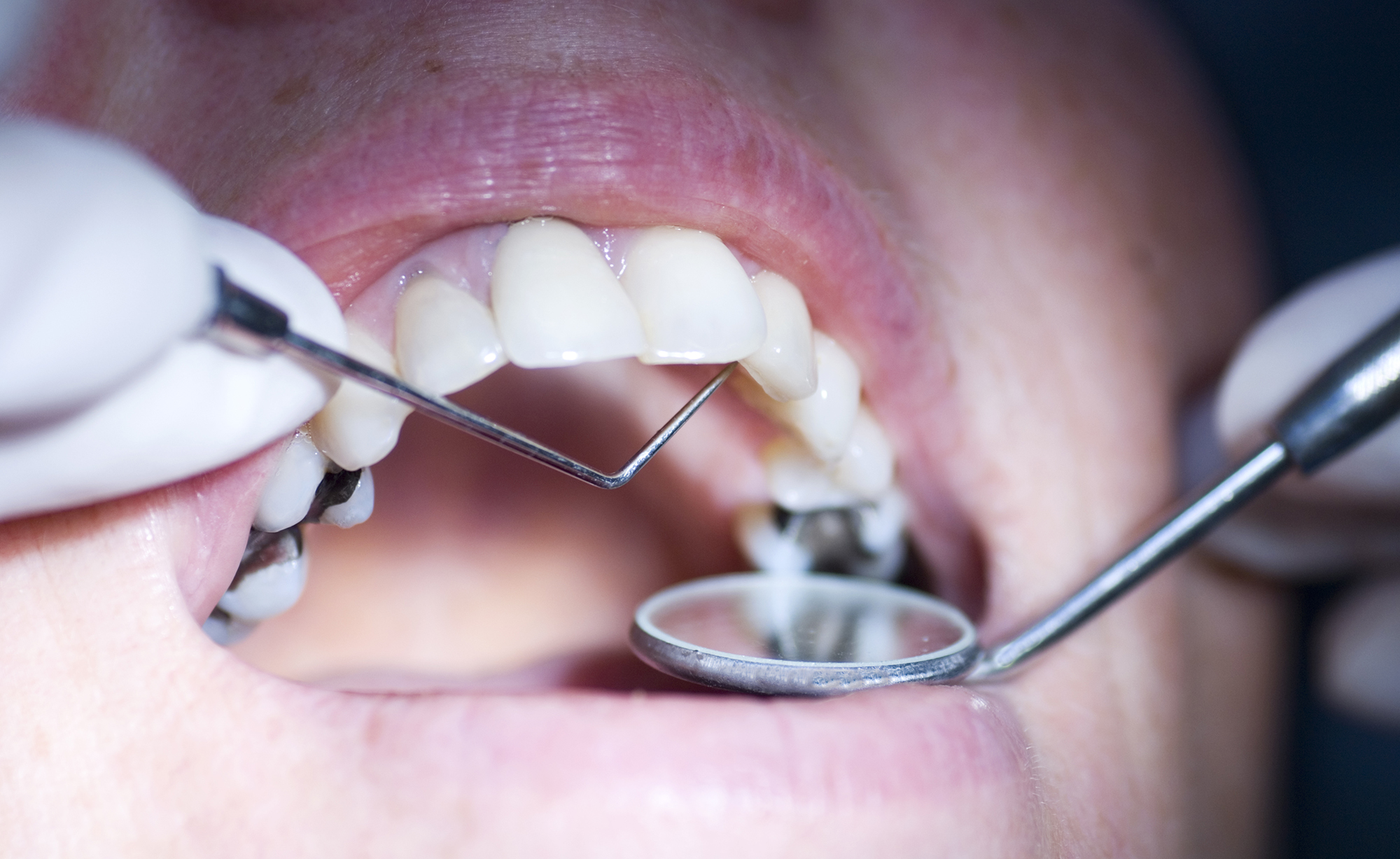 Close-up of mouth getting dental exam