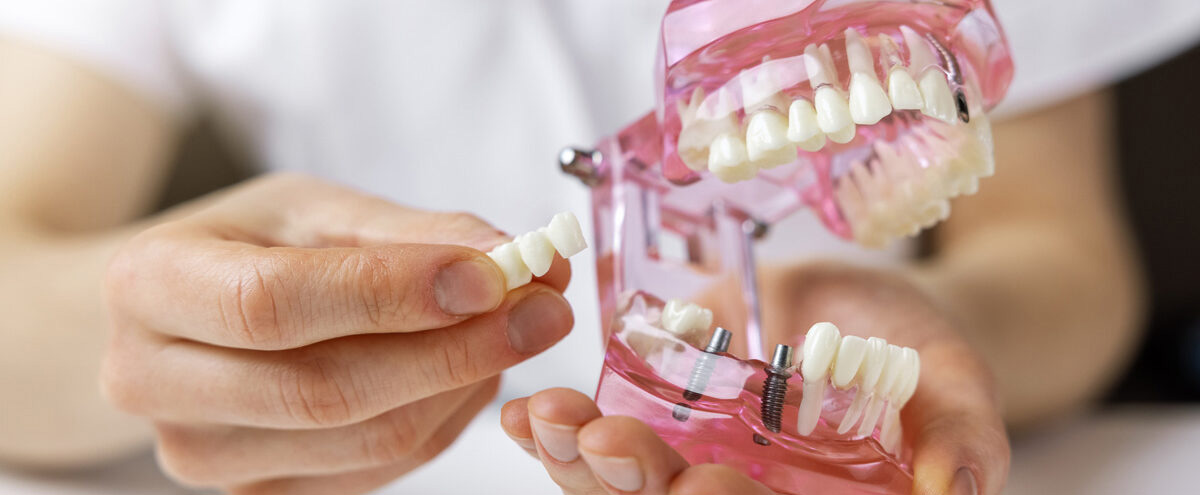 dental implants