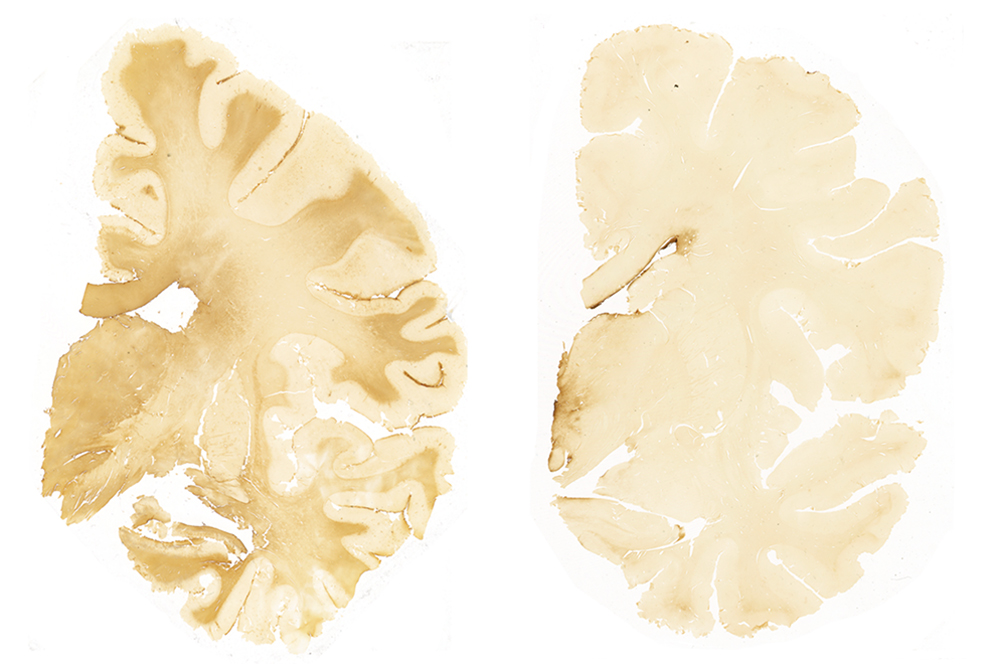 CTE-caused-by-brain-injury