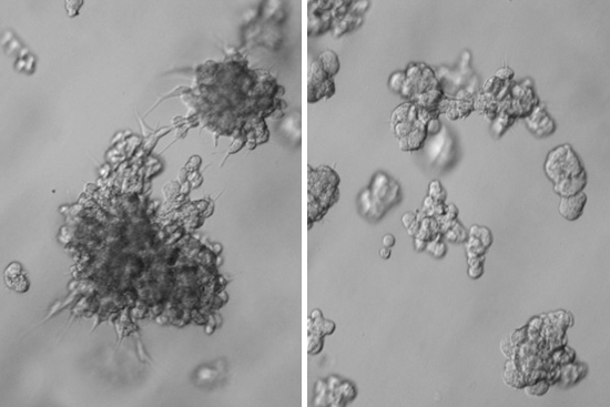 Human Mammory tumor before and after AhR treatment