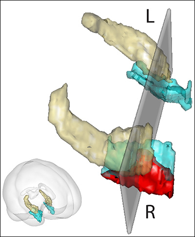 voxel-based morphometry brain analysis shows the hippocampus and entorhinal cortex brain regions