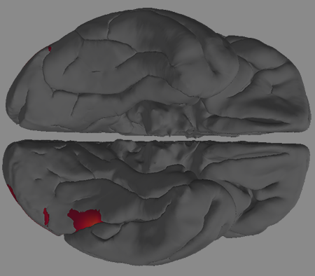 fMRI scan of a human dyslexic brain