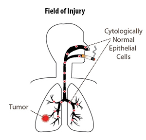 lung cancer field of injury diagram