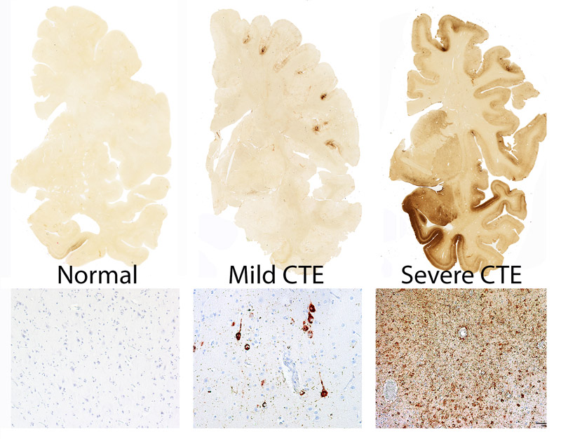 Microscopic images of tau, stained red, embedded in samples of normal, mild CTE, and severe CTE brain tissue