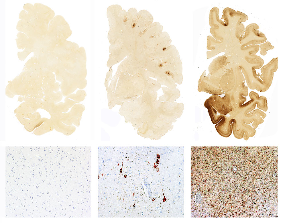 Normal.-Mild-CTE.-Severe-CTE-995px.jpg