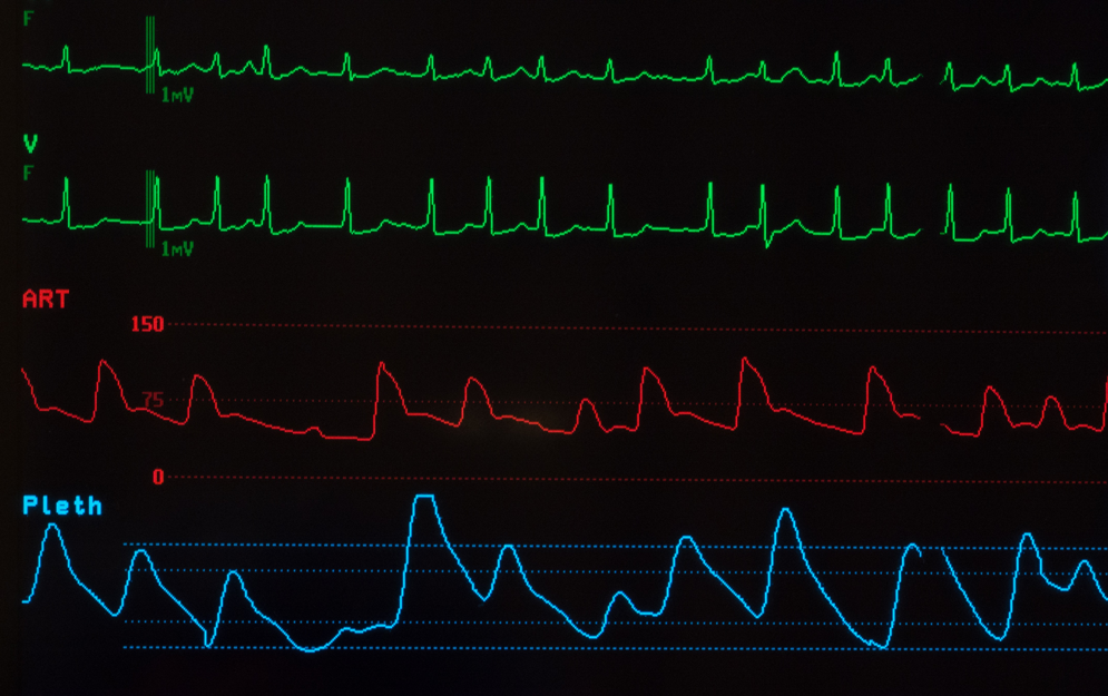 Close Up of Monitor Showing Atrial Fibrillation