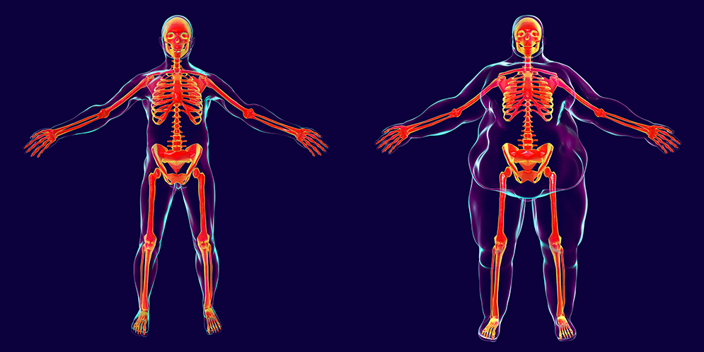 Obesity may be associated with an increased risk of progression, recurrence, and death for specific types of cancer.