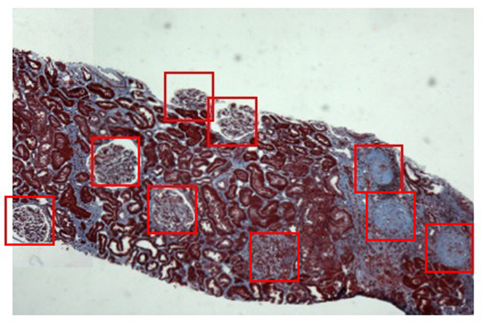 Sample visualization of Vijaya Kolachalama’s algorithm identifying sigs of illness in kidneys.