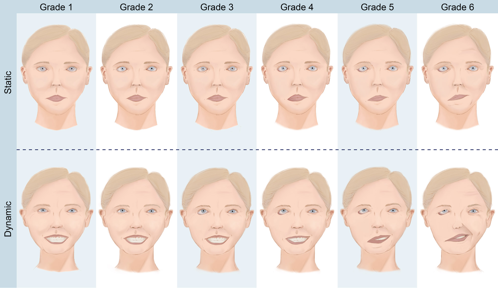 Face scale. Хаус Бракман шкала. Шкала Хаус-Бракмана неврита лицевого. House Brackmann шкала. Шкала оценки лицевого нерва.
