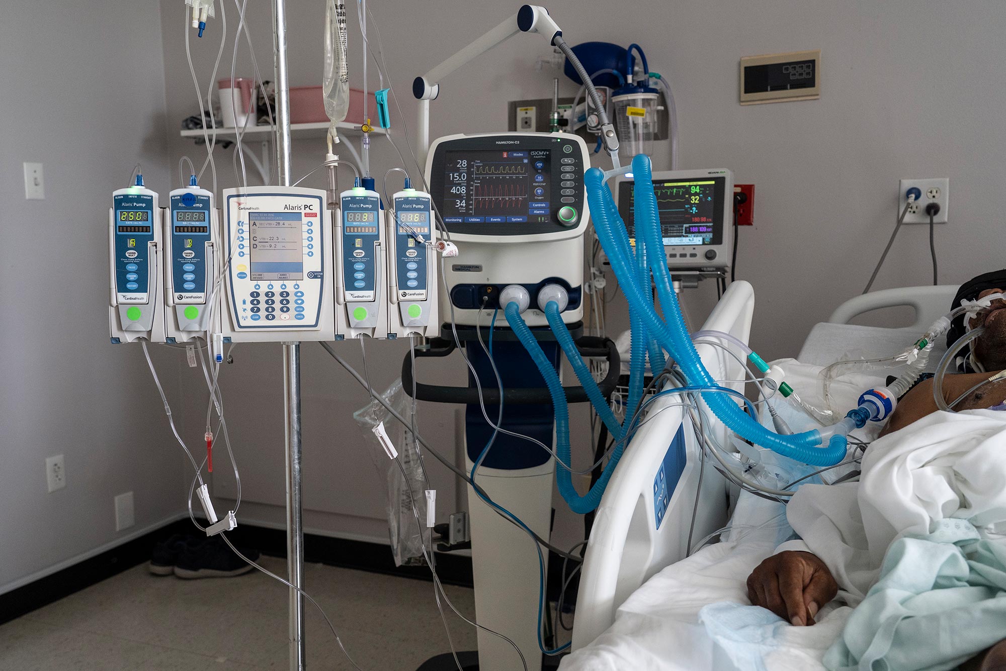 Photo of a hospital room in which a person, seen, partially, laying in a hospital bed on the right, hooked up to a ventilator on the left. Many tubes spill over from the machine towards the person. Photo was taken July 2, 2020 in HOUSTON, TX.