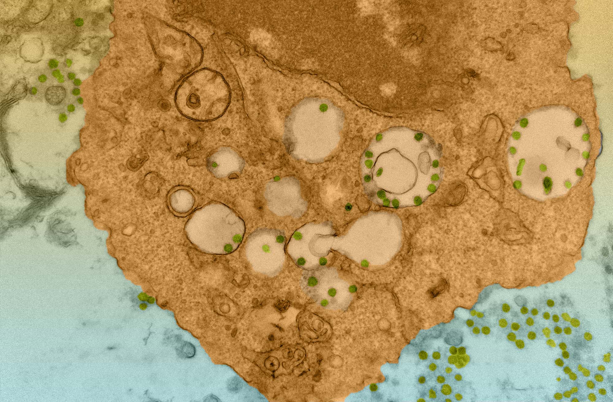 Image shoes CoV2 particles in microphages. A large burnt yellow blob is seen on a light teal background with specks of dark green dots and pale yellow, smaller circles in the middle of said blob.