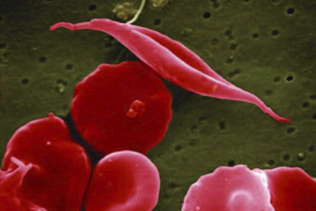 Image: An electron microscope image hows a blood cell altered by sickle cell disease, top. The altered red blood cell is shown in a half-moon/sickle shape while other normal cells around it are circular.