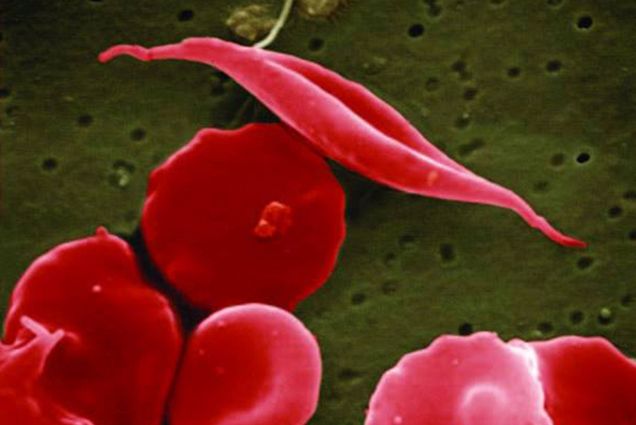 Image: An electron microscope image hows a blood cell altered by sickle cell disease, top. The altered red blood cell is shown in a half-moon/sickle shape while other normal cells around it are circular.