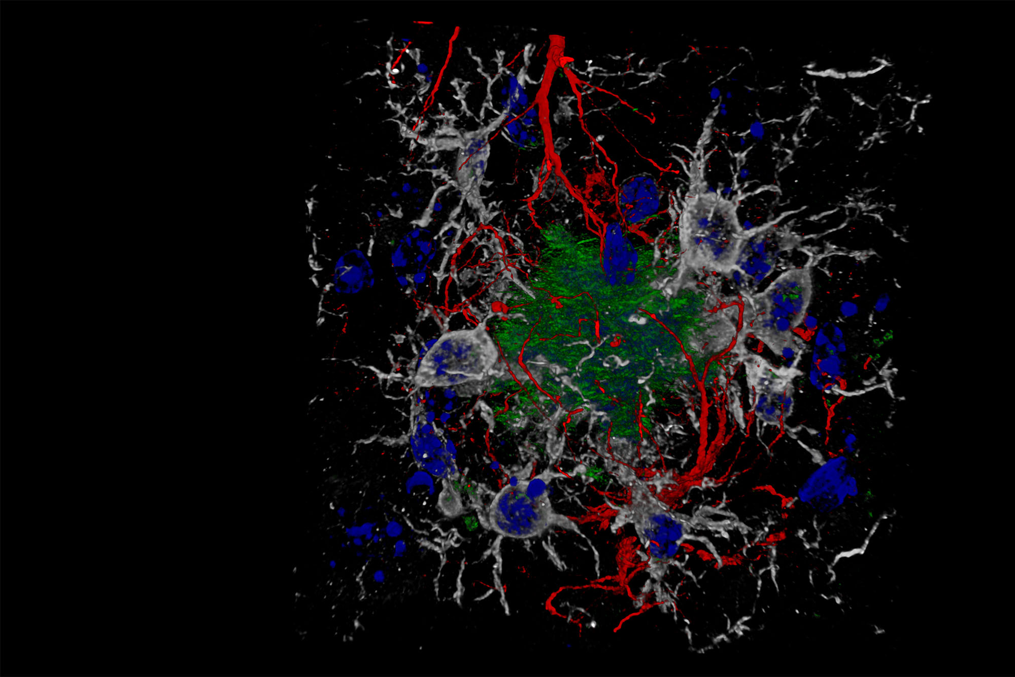 Photo: This image shows microglia and astrocytes, components of our brain's immune system, in the heat of battle against those beta-amyloid protein plaques, the drivers of the concatenation of events presented above. Being able to study them at this level of detail will allow us to better understand the pathology and, hopefully in the near future, to develop effective therapies against the origin of the disease. Image taken with reflection confocal and/or scanning spectral fluorescence microscope LEICA Stellaris 8. Objective: HCX PL APO 63x/1.30 Glyc W.D. 0.30 mm. Composite made from 43 Z-planes with LASX 3D software and post-processed with FIJI.