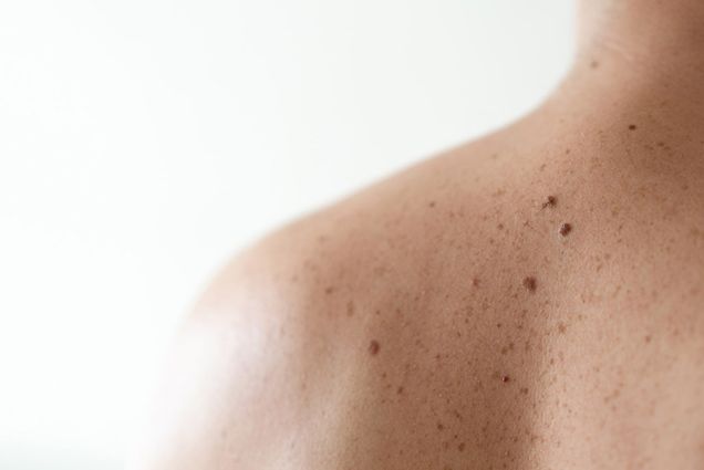 Photo: Photo of skin cancer on someone's back