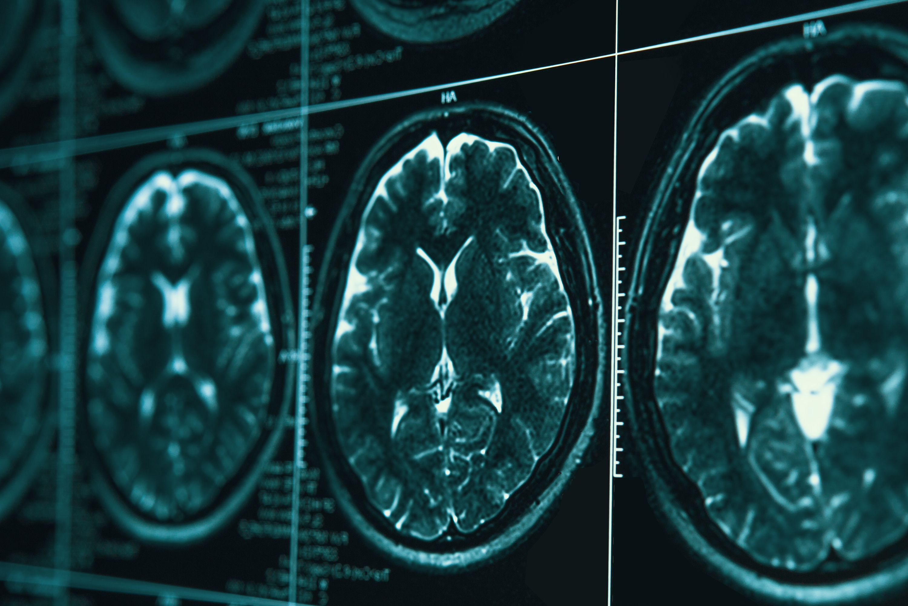 MRI or magnetic resonance image of head and brain scan. Close up view, toned image