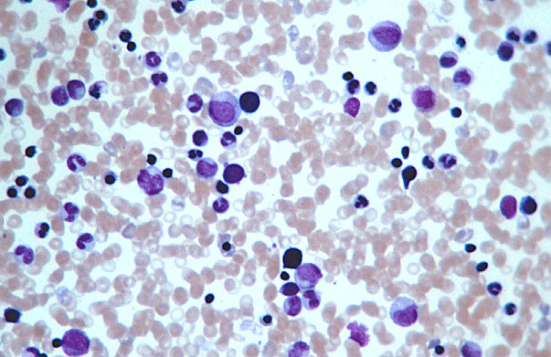  bone marrow smear 