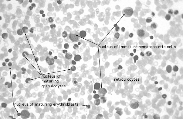  bone marrow smear, myeloblasts and reticulocytes