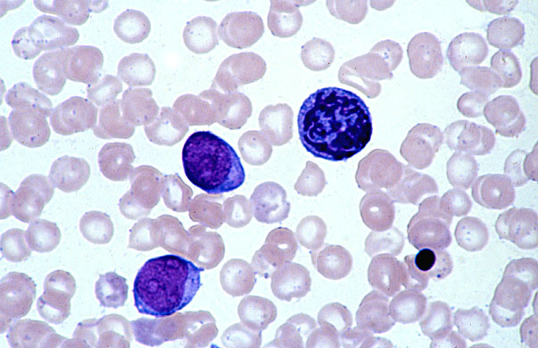  bone marrow smear, myeloblasts